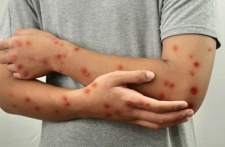 Brasil registra 88 casos de Mpox em 2026