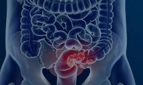 Março Azul: exames para rastrear câncer de intestino triplicam no SUS